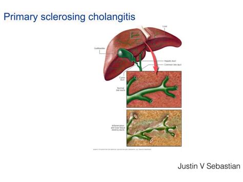 Primary Sclerosing Cholangitis Ppt