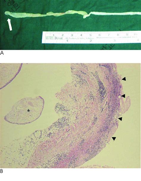 Photographs Of Sparganum Obtained By Surgical Removal A An Ivory