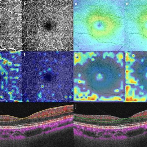 Macular OCT Angiography OCTA And OCT Images With Heatmaps For