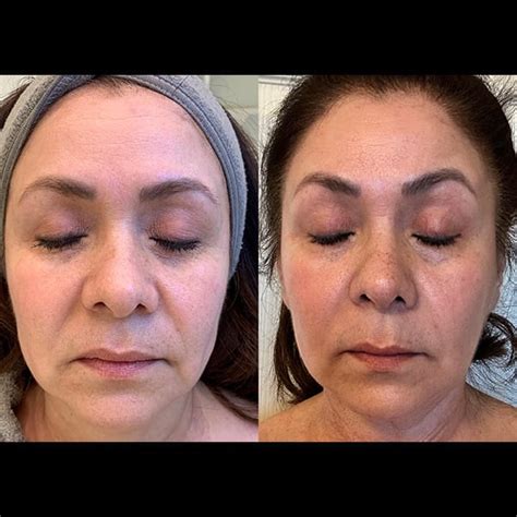 Halo Laser In San Antonio Tx Cutella Medical Spa