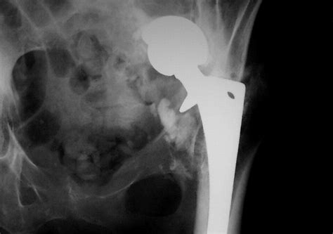 Acetabular Prosthetic Protrusion And Sepsis The Journal Of Arthroplasty