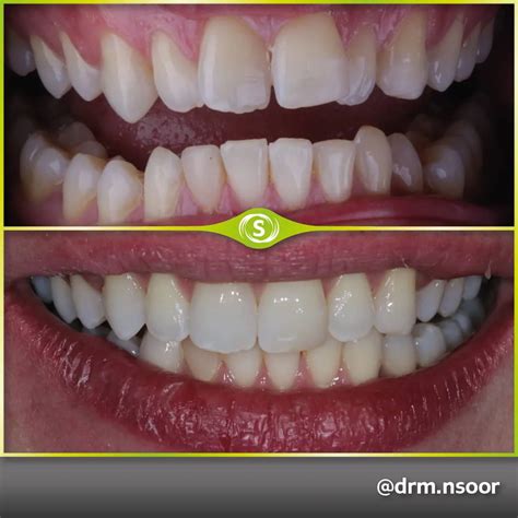 Before and After Teeth Straightening • Synergy Dental Clinic