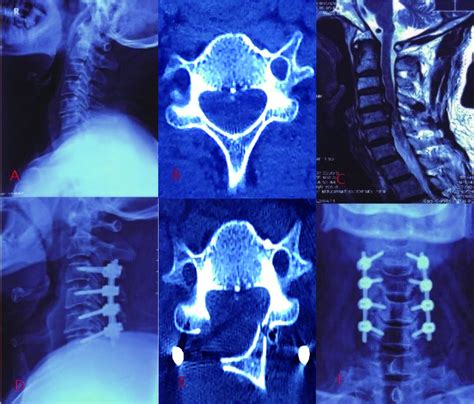 Freehand Regional Techniques For Subaxial Cervical Pedicle Screw