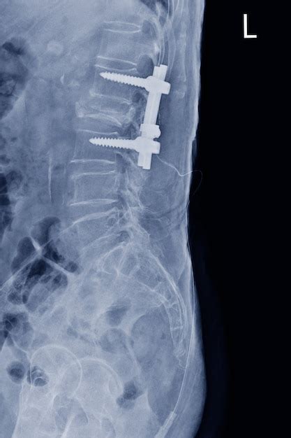 Radiografía de película ls columna vista lateral que muestra una