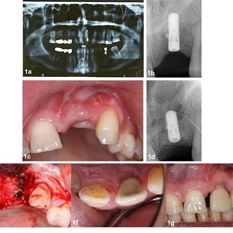 Case Presentation Of Retrograde Periimplantitis On Tooth And Its