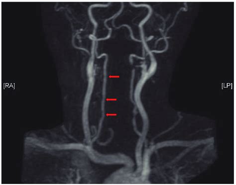 Variation In The Origin Of Left Vertebral Artery A Case