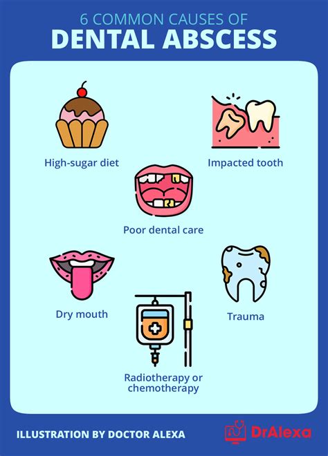 Doctor Explains Dental Abscess Tooth Abscess Causes Symptoms Treatment Nbkomputer