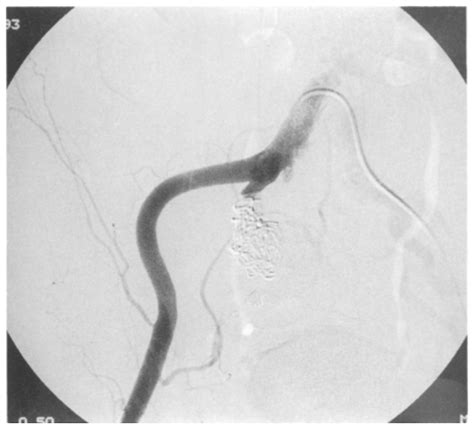 Completion Angiogram Demonstrates Selectively Embolized Internal Iliac