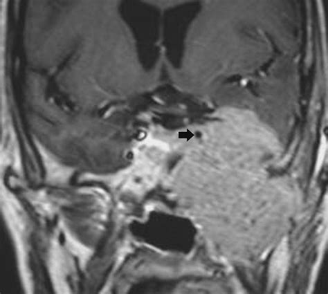 Cavernous Sinus Mri