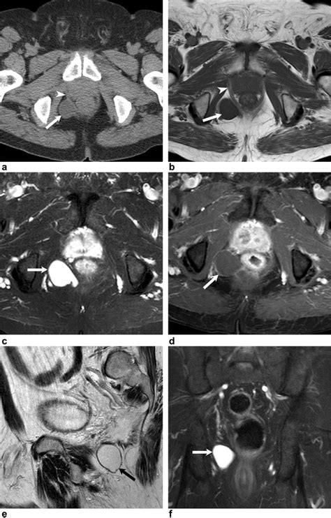 68 Year Old Male With A Mass In The Tailbone A Axial Ct Image Of The