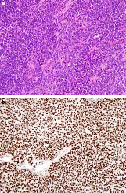 Poorly Differentiated Synovial Sarcoma A With 3 Tle1 Expression B