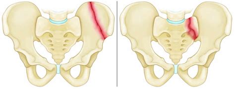 Pelvic Fracture Types Causes Signs Symptoms Diagnosis And Treatment