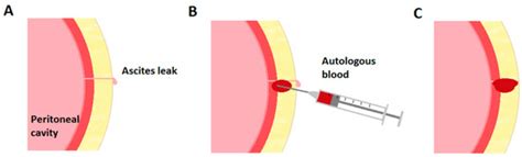 Medical Sciences Free Full Text Autologous Blood Patch For