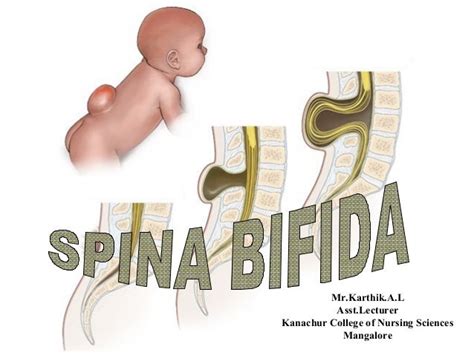 Spina Bifida