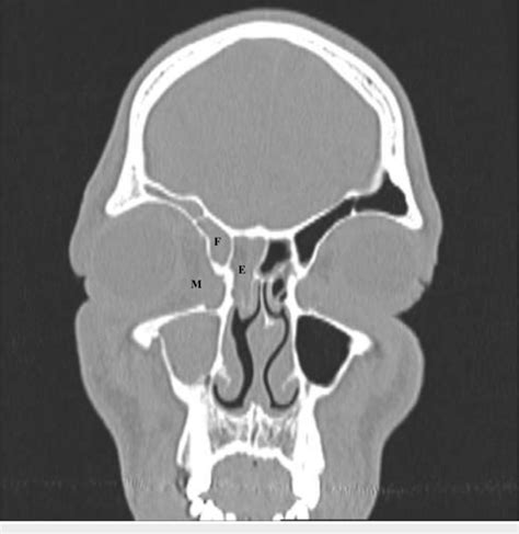 Ethmoid Air Cells Opacified