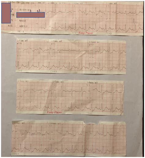 The Lead Electrocardiography Ecg Showed Wide Spread St Depression