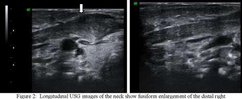 Figure 2 From Fibromatosis Colli In A Neonate A Case Report Semantic Scholar