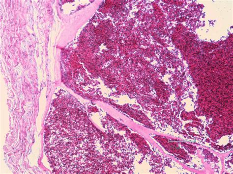 Photomicrograph Of The Lesion Showing A Cavernous Hemangioma With