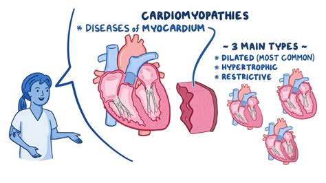 Cardiomyopathy: Definition, Causes, Symptoms, And Treatment, 42% OFF