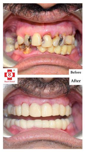 Dental Flap Surgery | Types of Flaps in Dentistry