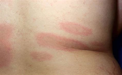 Lyme Disease - Rash, Causes, Symptoms, Diagnosis and Treatment