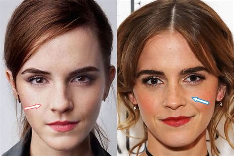 Emma Watson Plastic Surgery Before And After Nose Job Pictures Nose