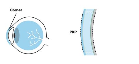 Qué es la queratoplastia penetrante Hospital Clínic Barcelona