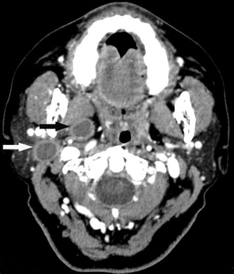 Unilateral Parotid Gland Involvement With Synchronous Multiple Basal