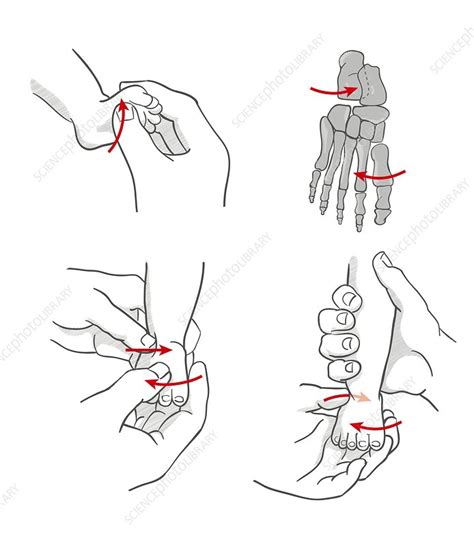 Ponseti Method For Club Foot Illustration Stock Image C038 1392