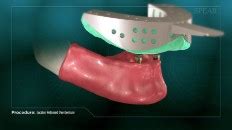 Locator Retained Overdenture | Virginia Dental Center