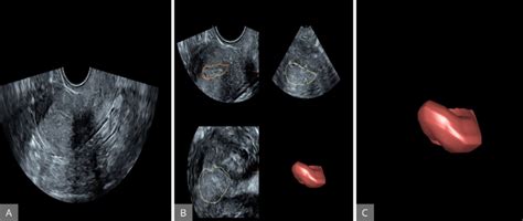 Assessment Of Endometrial Cavity Volume By Three Dimensional Power