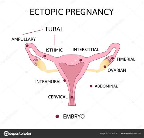 Embarazo ectópico Tipos de embarazo tubular ovárico abdominal