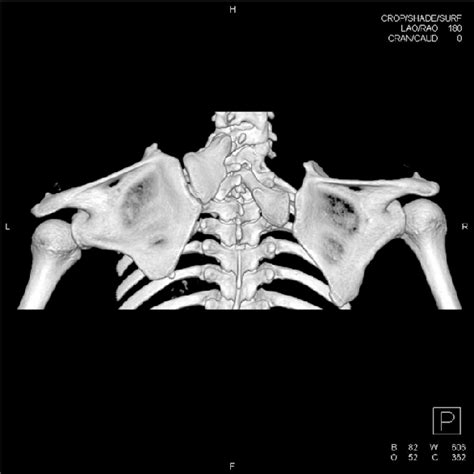 Computed Tomography Of The Upper Chest Showed Cervical Fusion And Download Scientific Diagram