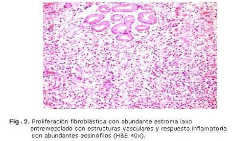 Tumor de Vanek o pólipo fibroide inflamatorio Reporte de un caso