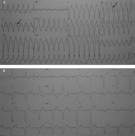 Pacemaker Mediated Tachycardia Heart