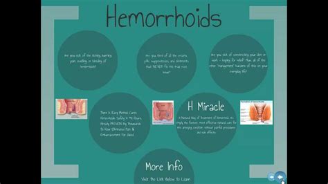 Internal Hemorrhoids Treatment Effective Internal Hemorrhoids Treatment