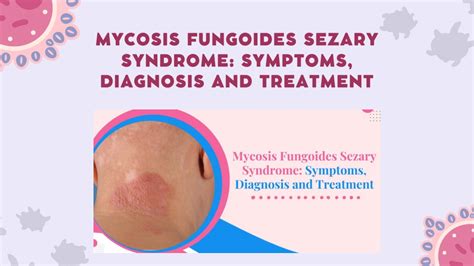 PPT What Is Mycosis Fungoides Sezary Syndrome PowerPoint