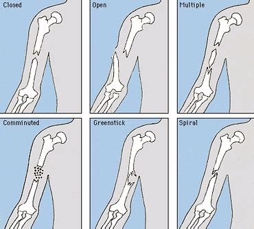 Skeletal System Diseases - Biology-Locomotor and Circulatory system