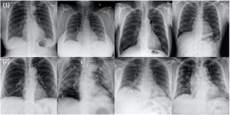 Frontiers COVID Net CXR 2 An Enhanced Deep Convolutional Neural