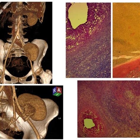 Pdf Kidney Autotransplantation For Multiple Renal Artery Aneurysms A