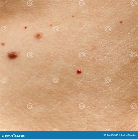 Birthmarks On The Skin As A Background Stock Image Image Of Mole