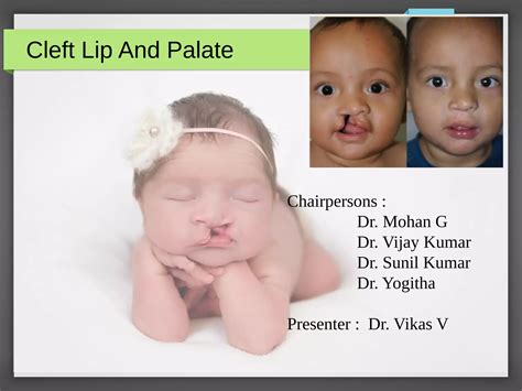 Cleft Lip And Palate Ppt