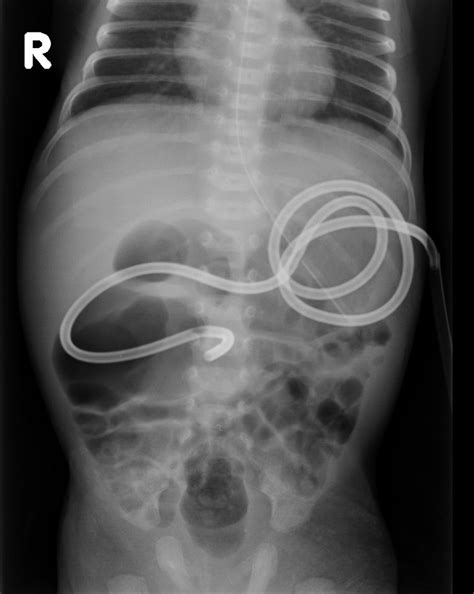 Scaphoid Abdomen Duodenal Atresia One May Occasionally Note