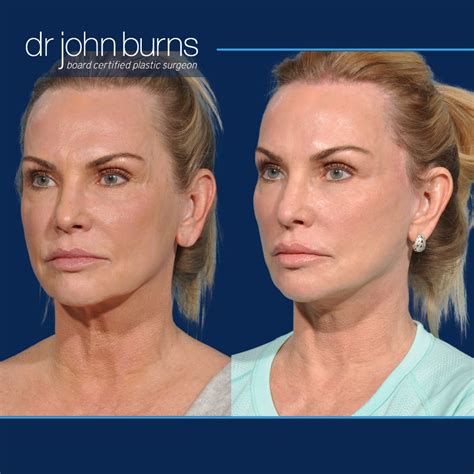 Demystifying The Deep Plane Facelift Smas Lift Dr John Burns Dr