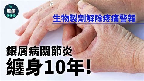 銀屑病關節炎纏身10年！生物製劑解除疼痛警報 Am730