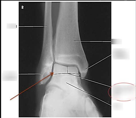 AP Oblique Ankle Mortise View Anatomy Diagram Quizlet