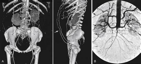 acute aortic occlusion clinical tree