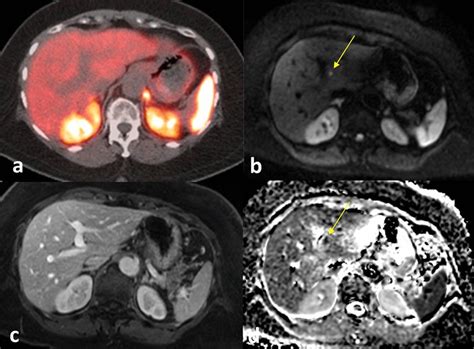 70 Year Old Female With Ileal Neuroendocrine Tumor With Left Hepatic Download Scientific