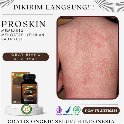 Jual Proskin 100 Original Obat Biang Keringat Gatal Pada Kulit