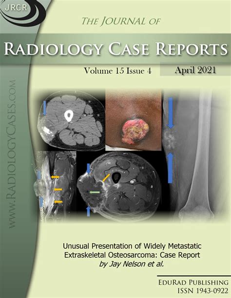 Acute soft head syndrome in a sickle cell disease patient | Journal of ...